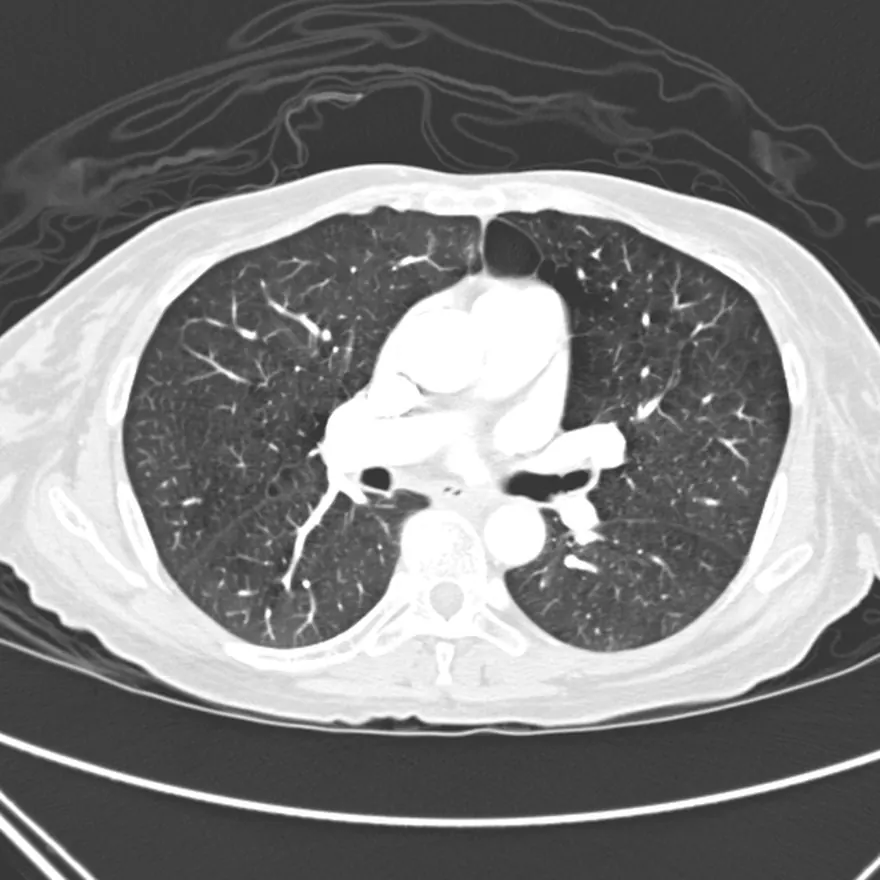 Tomografía de tórax, corte axial