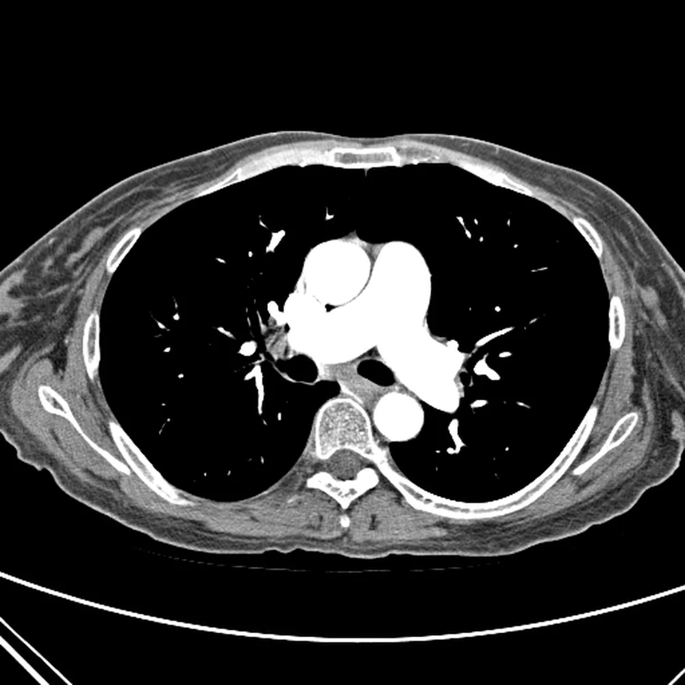 Tomografía de tórax con contraste, corte axial en ventana de mediastino