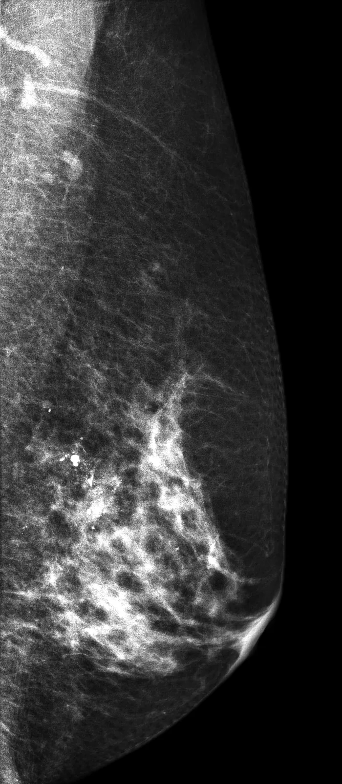 Mamografía, proyección oblicua mediolateral
